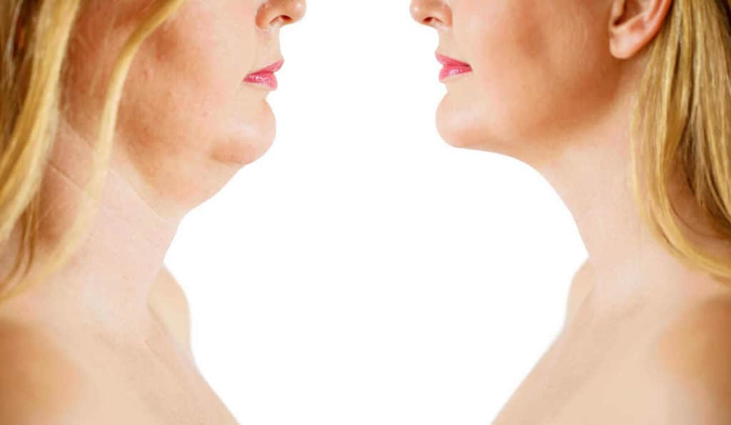 Double Chin treatment Brentwood before and after results