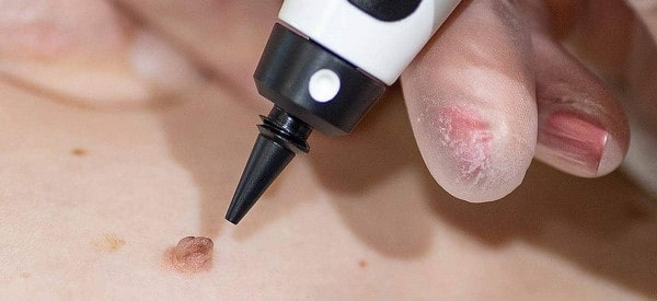 After Skin Tag Removal Brentwood
