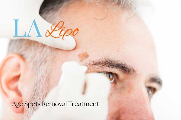 What Are the Most Effective Treatments for Age Spots Brentwood?