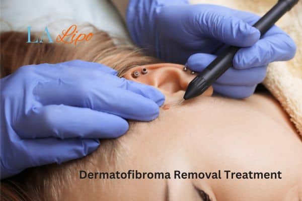 Dermatofibroma Removal Treatment Brentwood