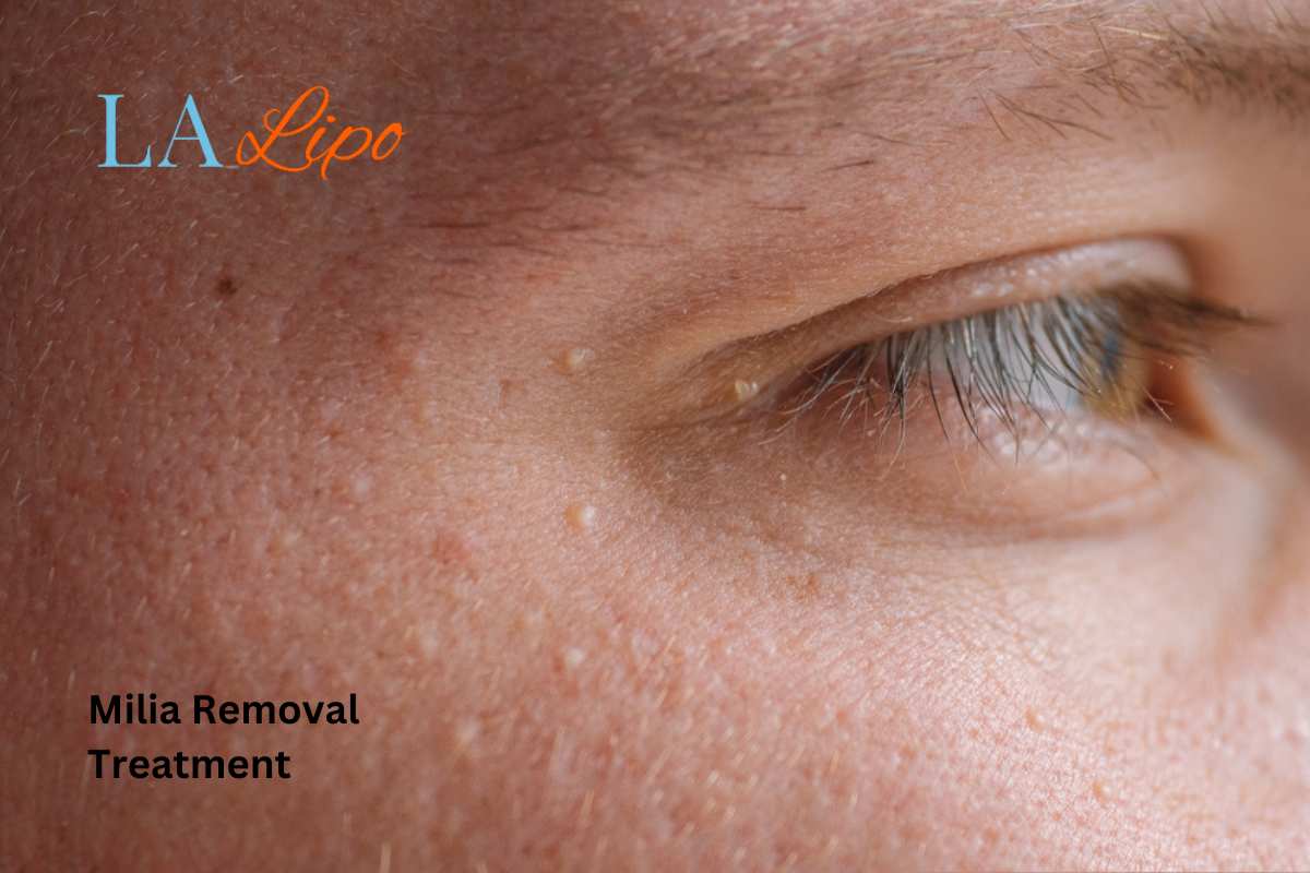Cryopen Milia Removal: Is It the Easiest and Safest Option Brentwood?