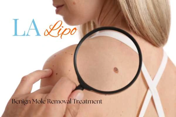 Woman having her inspection of blemish before mole removal Brentwood