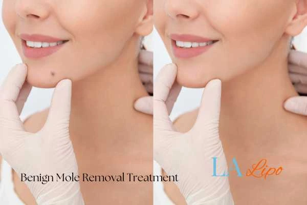 woman's before and after mole removal Brentwood results