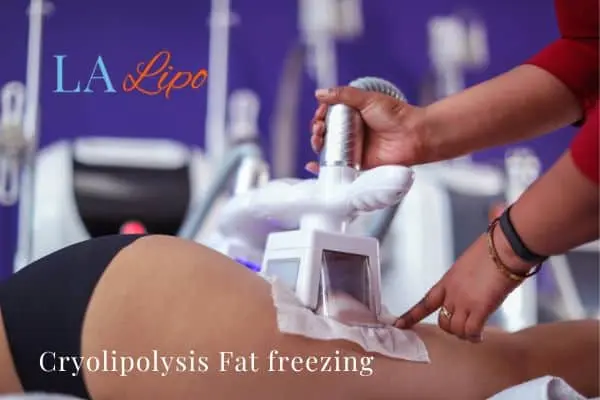 women getting fat freezing Brentwood