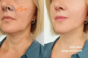 hi-fu for wrinkles Brentwood before and after results
