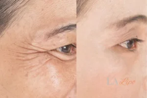 Before and after results of woman - HI-fu wrinkles reduction treatment Brentwood