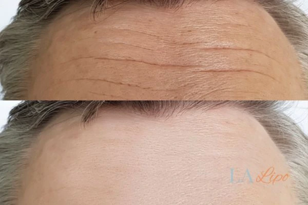 results of HIFU Brentwood on mans forehead to help reduce lines and wrinkles