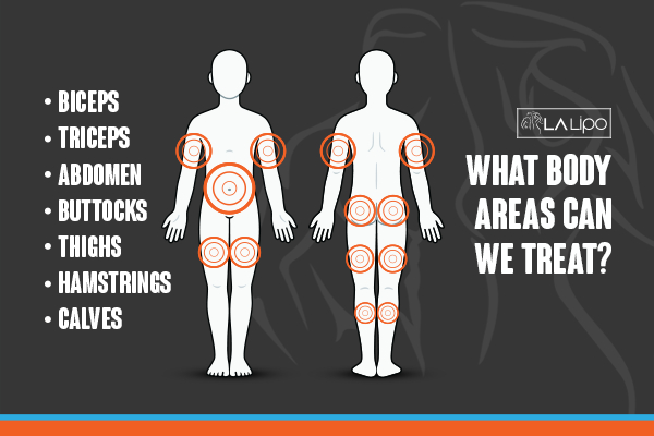 Graphic to show areas you can have LA-EMS Body Sculpting Brentwood treatment.