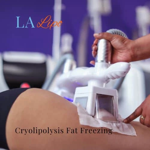 fat freezing - Cryolipolysis Brentwood