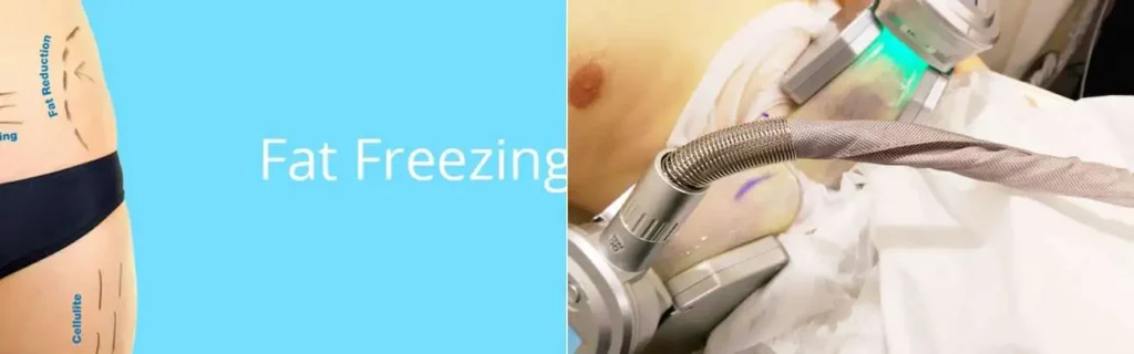 Fat freezing Brentwood on multiple areas of the body