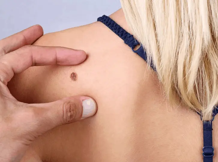 woman having mole removal Brentwood consultation before treatment.