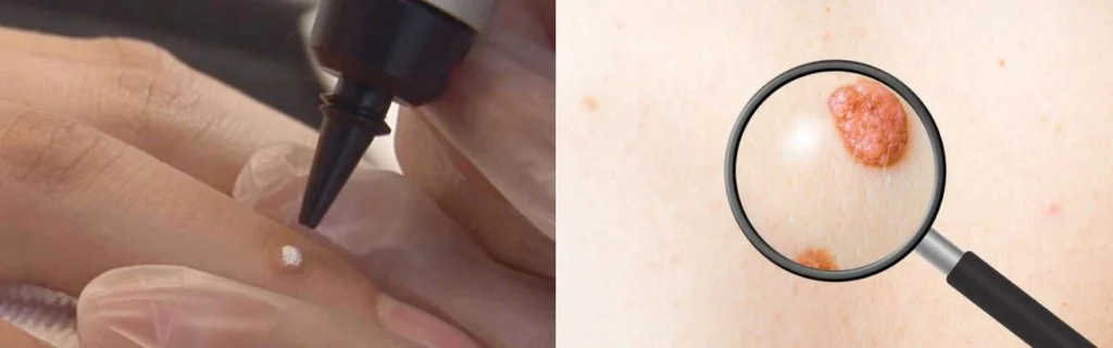 Person getting moles removed with cryopen Brentwood