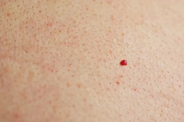 close up of a cherry angioma Brentwood