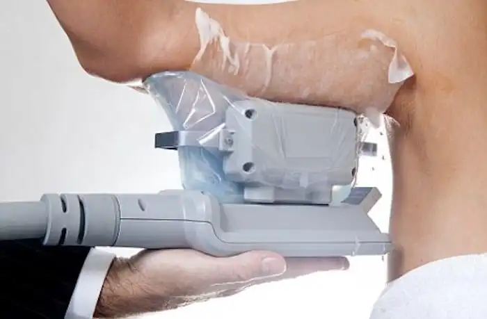 Picture of fat freezing Brentwood on the upper arms.