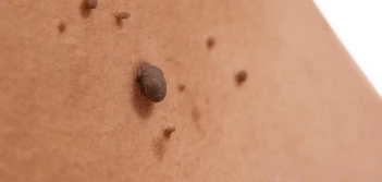 image of a skin tag Brentwood