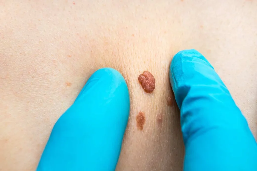 Consultant examining a skin tag Brentwood