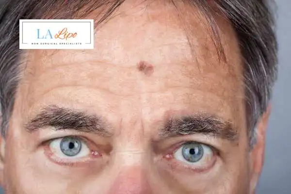 Solar Lentigo Removal Brentwood image of man with mark on his forehead