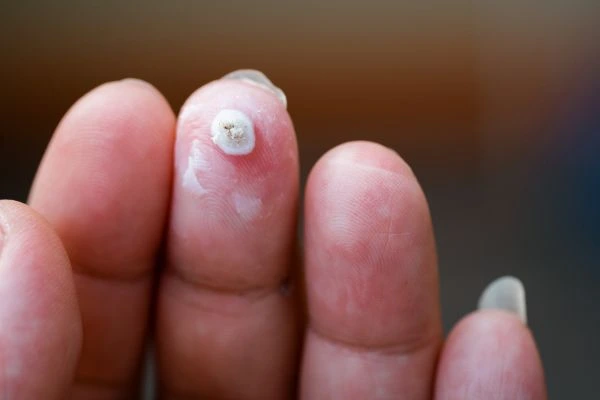 wart on person finger - cryotherapy to treat from LA LIPO Brentwood