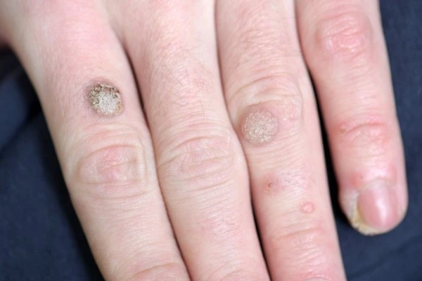 photo of warts on person hand - see wart removal Brentwood from LA LIPO