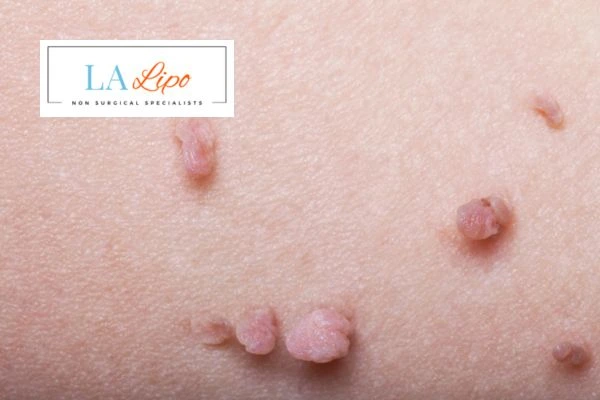 Does cryopen skin tag removal Brentwood hurt? Find out now call our team today!