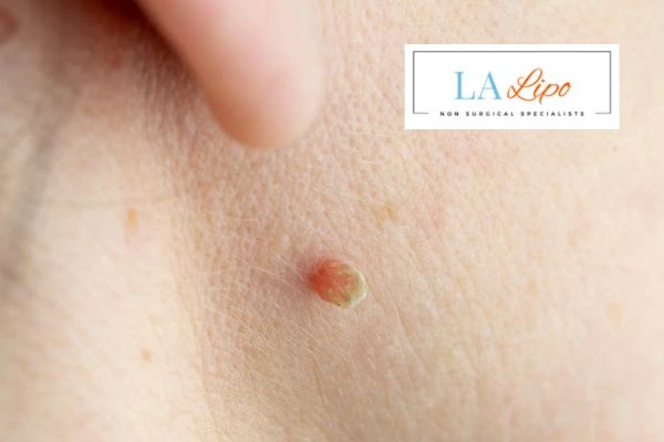Book skin tag removal Brentwood today speak to our team now!