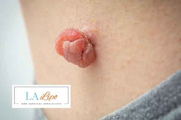Interested in skin tag removal Brentwood? Concerned about the pain? Find out more today!