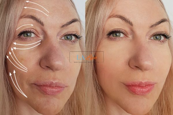 Morpheus 8 results Brentwood face lift.
