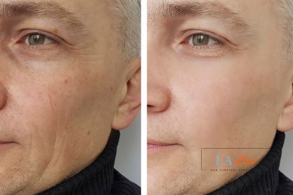 See the amazing results of Morpheus8 Treatment Brentwood!