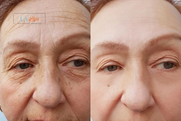 The powerful benefits of Morpheus8 Treatment Brentwood - Call Our team today!