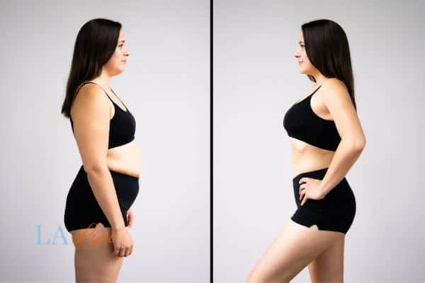 Picture of womans before and after using LA-EMS body sculpting to improve her core strength Brentwood