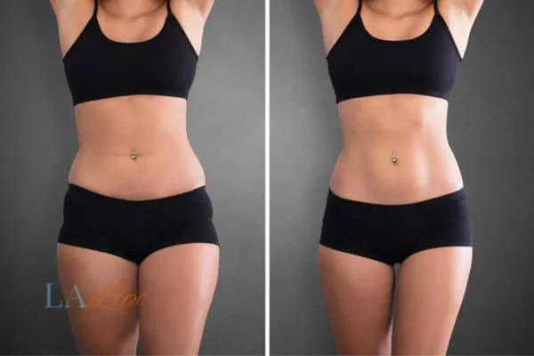 before and after results of non-surgical treatment to help a woman's body image and mental health Brentwood
