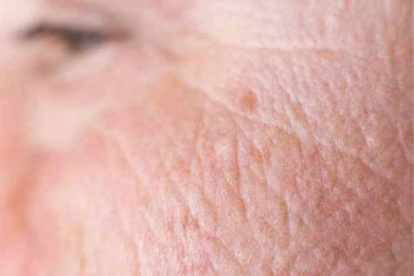 close up picture of a woman's face showing an age spot Brentwood