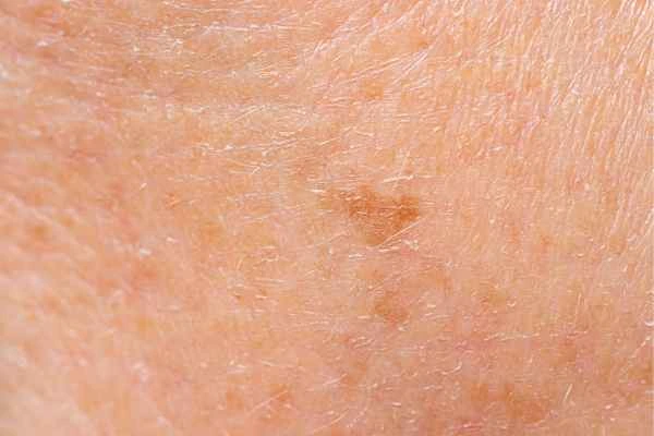 close up picture of age spots Brentwood