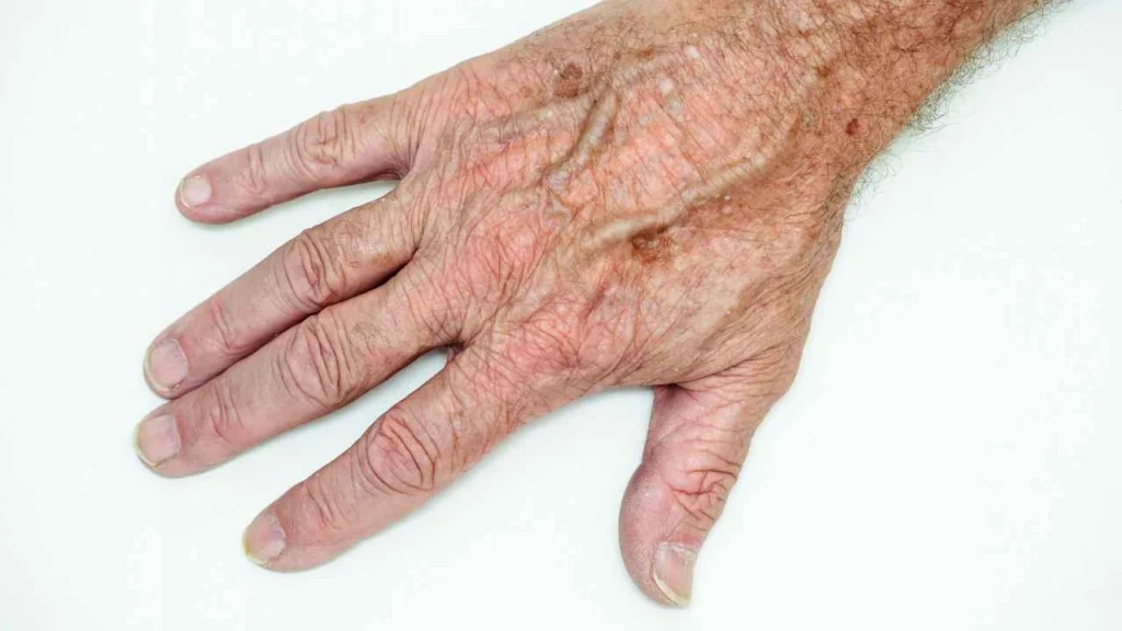 Male hand showing age spot Brentwood