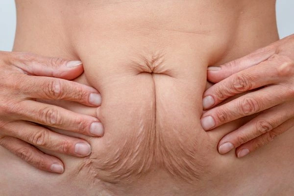 Image of a woman's stomach with loose skin - example of skin tightening Brentwood options