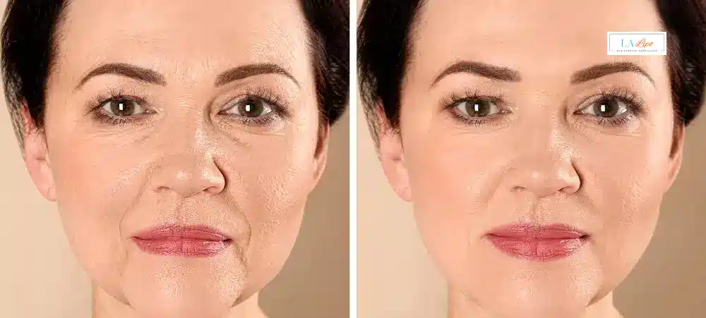 How Long Does It Take to See Results and How Long Do They Last Brentwood?