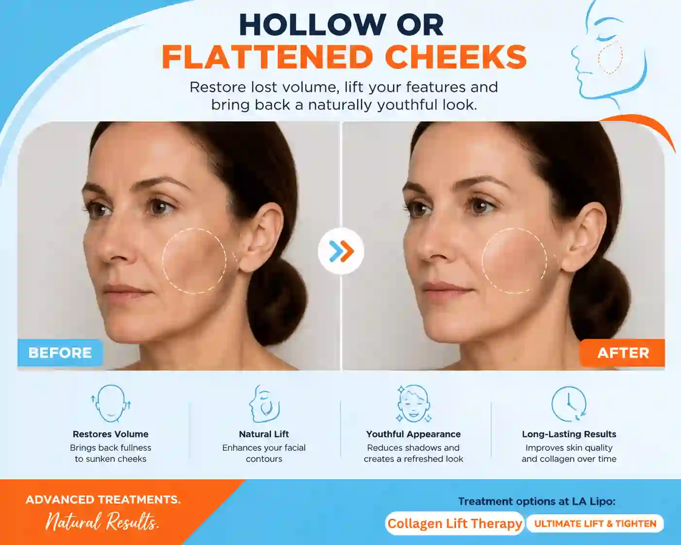 Sign #4: Hollow or Flattened Cheeks Brentwood